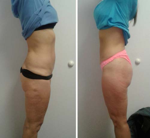 Booty Lift Before and After in Oklahoma City OKC