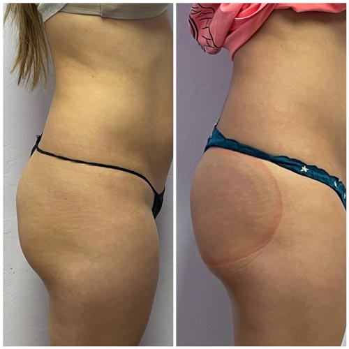 Booty Lift Before and After in Oklahoma City OKC