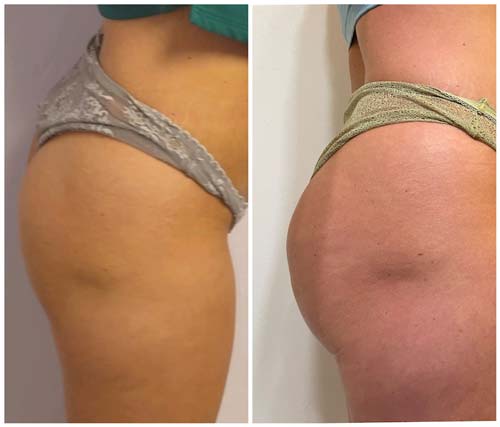 Booty Lift Before and After in Oklahoma City OKC