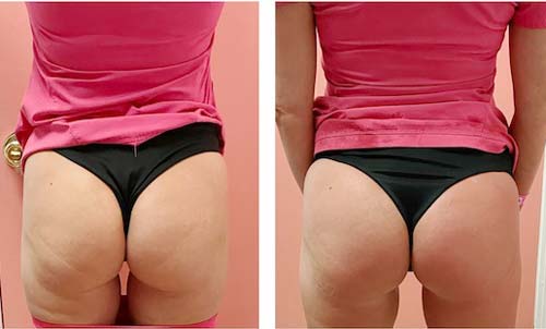 Booty Lift Before and After in Oklahoma City OKC