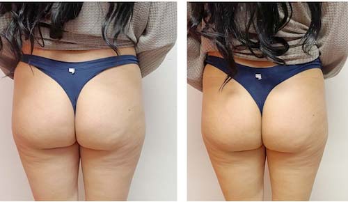 Booty Lift Before and After in Oklahoma City OKC