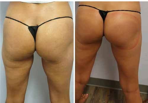 Booty Lift Before and After in Oklahoma City OKC