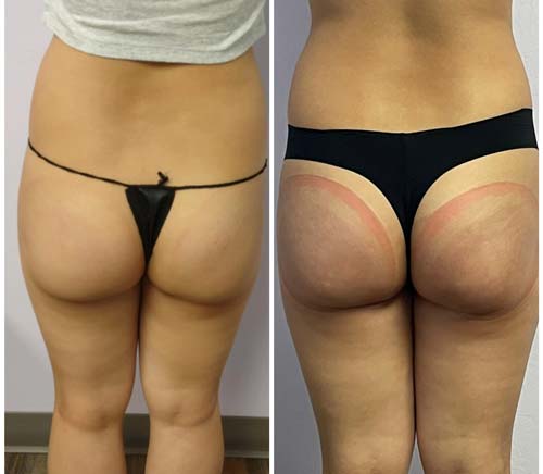 Booty Lift Before and After in Oklahoma City OKC