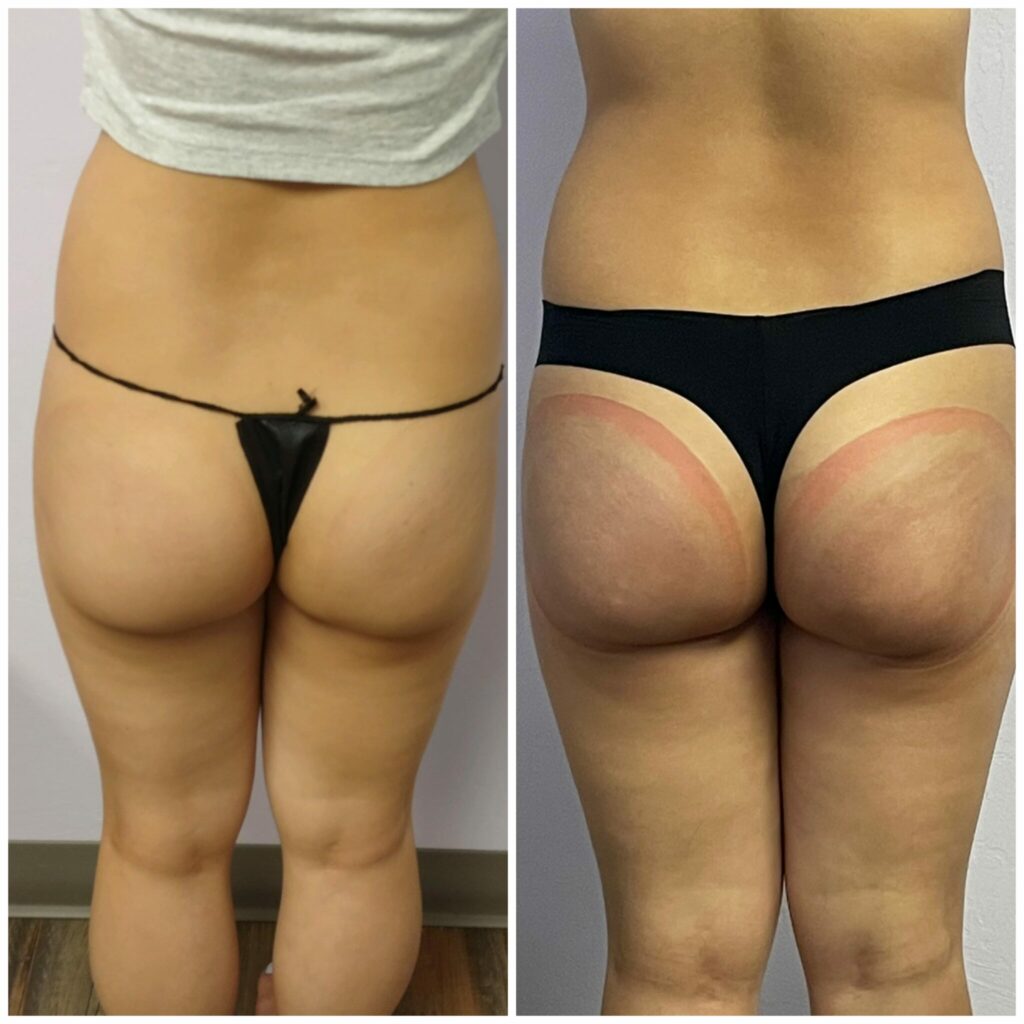  Booty Lift Before and After in OKC