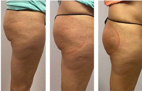 Body Sculpting Before and After in Oklahoma City OKC 