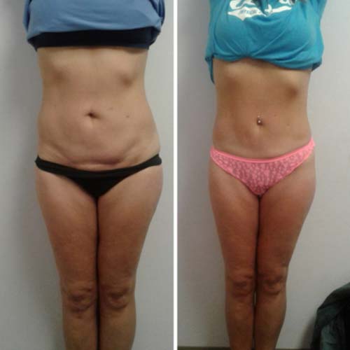 Body Sculpting Before and After in Oklahoma City OKC 