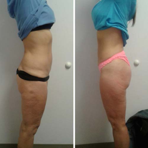 Body Sculpting Before and After in Oklahoma City OKC 