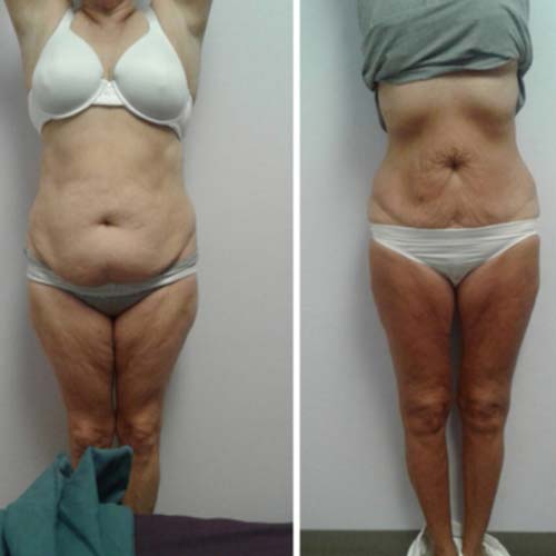 Body Sculpting Before and After in Oklahoma City OKC 