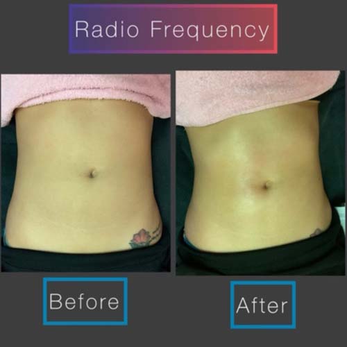 Body Sculpting Before and After in Oklahoma City OKC 