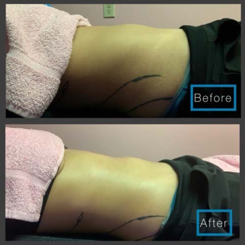 Body Sculpting Before and After in Oklahoma City OKC 