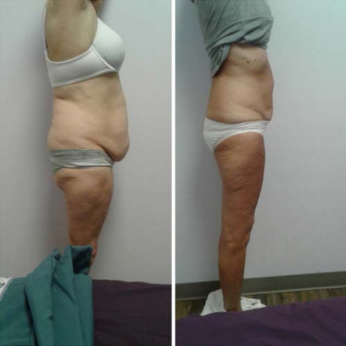 Body Sculpting Before and After in Oklahoma City OKC 