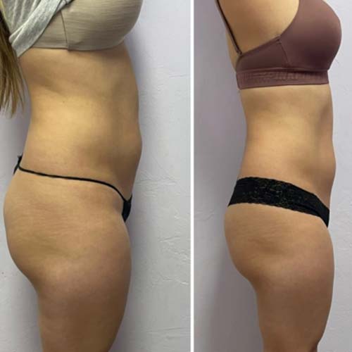 Body Sculpting Before and After in Oklahoma City OKC 