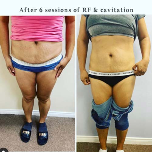 Body Sculpting Before and After in Oklahoma City OKC 