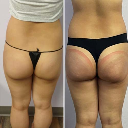 Body Sculpting Before and After in Oklahoma City OKC 