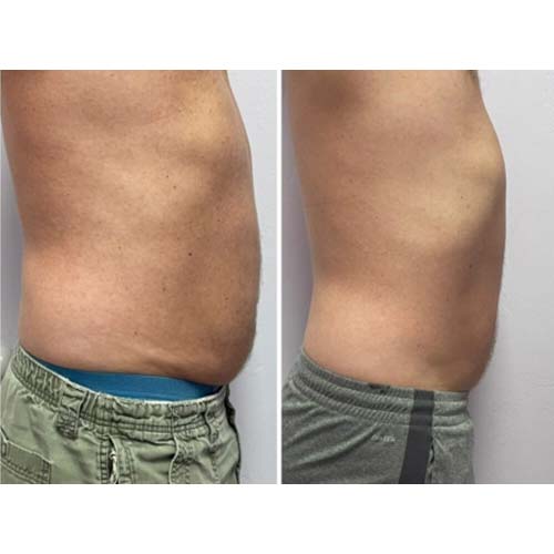 Body Sculpting Before and After in Oklahoma City OKC 