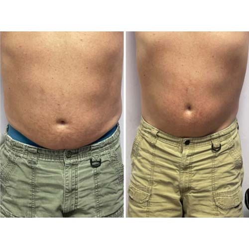 Body Sculpting Before and After in Oklahoma City OKC 