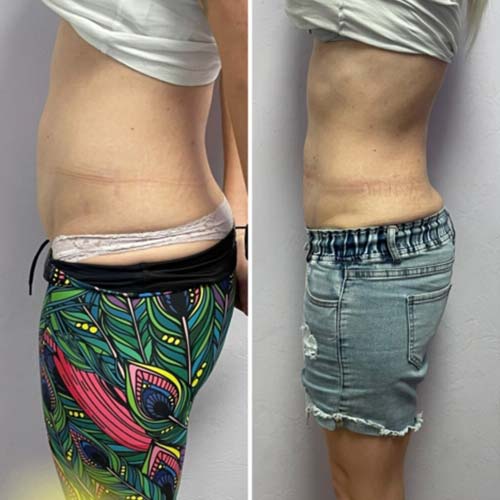 Body Sculpting Before and After in Oklahoma City OKC 