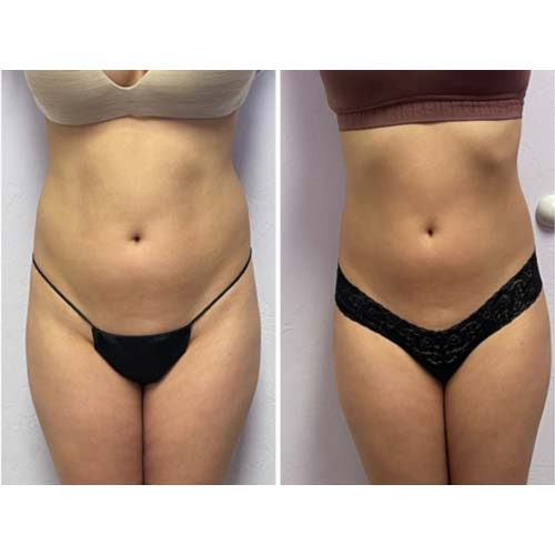 Body Sculpting Before and After in Oklahoma City OKC 