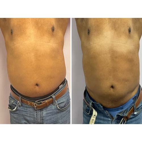 Body Sculpting Before and After in Oklahoma City OKC 