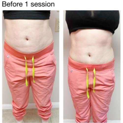 Body Sculpting Before and After in Oklahoma City OKC 