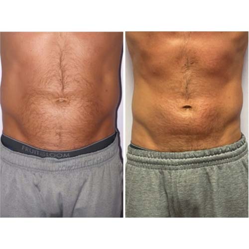 Body Sculpting Before and After in Oklahoma City OKC 