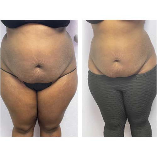 Body Sculpting Before and After in Oklahoma City OKC 