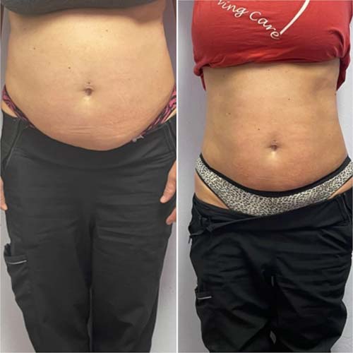 Body Sculpting Before and After in Oklahoma City OKC 