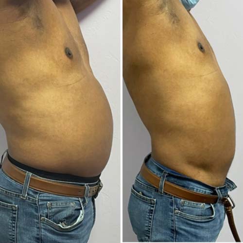 Body Sculpting Before and After in Oklahoma City OKC 