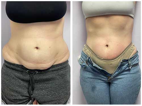 Body Sculpting Before and After in Oklahoma City OKC 