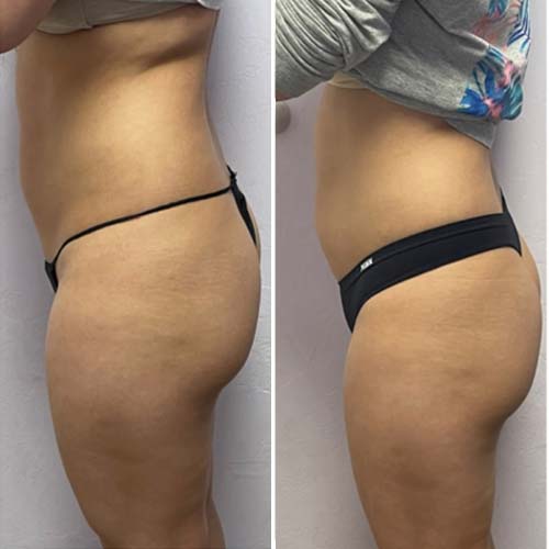 Body Sculpting Before and After in Oklahoma City OKC 