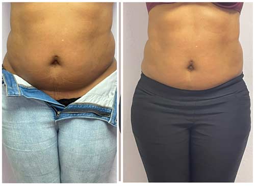 Body Sculpting Before and After in Oklahoma City OKC 