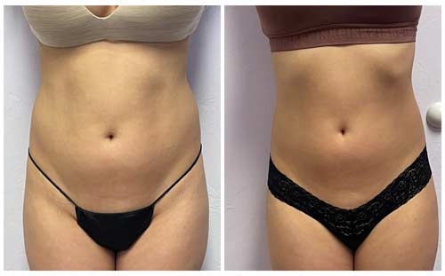 Body Sculpting Before and After in Oklahoma City OKC 