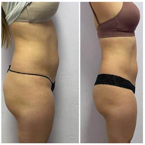 Booty Lift Before and After in Oklahoma City OKC