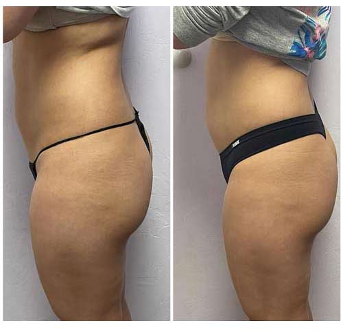 Booty Lift Before and After in Oklahoma City OKC