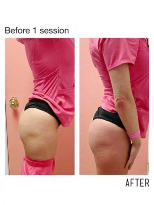 Booty Lift Before and After in Oklahoma City OKC