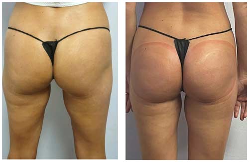 Booty Lift Before and After in Oklahoma City OKC