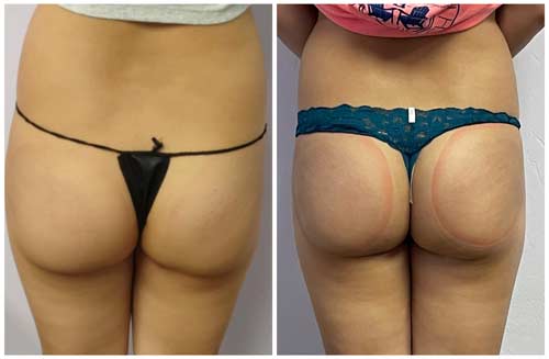 Booty Lift Before and After in Oklahoma City OKC