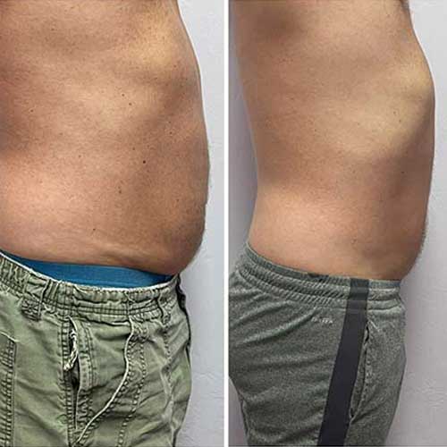 Vevazz Laser Light Lipo Therapy Before and After 