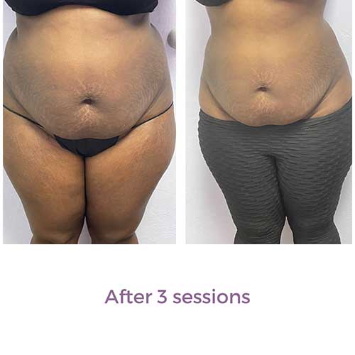 Vevazz Laser Light Lipo Therapy Before and After 