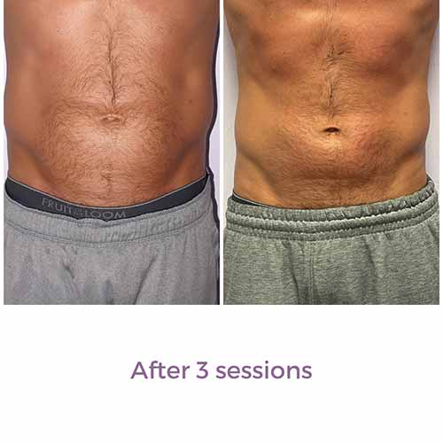 Vevazz Laser Light Lipo Therapy Before and After 