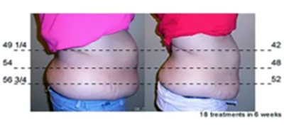 Vevazz Laser Light Lipo Therapy Before and After 