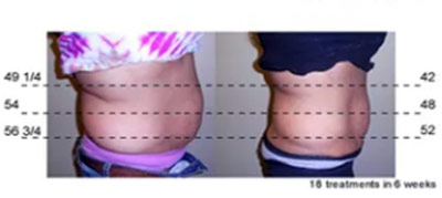 Vevazz Laser Light Lipo Therapy Before and After 