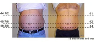 Vevazz Laser Light Lipo Therapy Before and After 