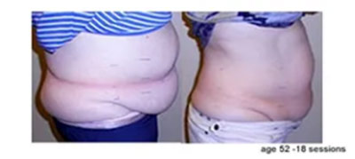 Vevazz Laser Light Lipo Therapy Before and After 