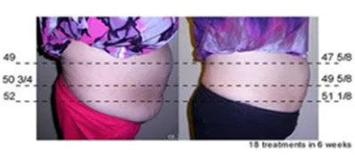 Vevazz Laser Light Lipo Therapy Before and After 