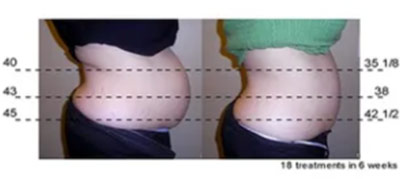 Vevazz Laser Light Lipo Therapy Before and After 