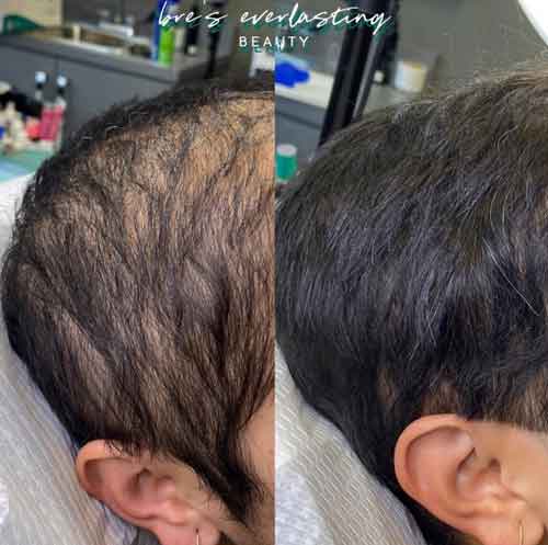 ProCell Microchanneling Treatment Before and After Pictures in Oklahoma City, OK