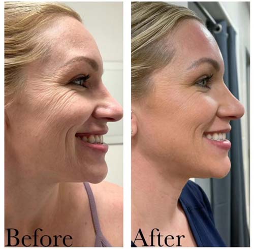 ProCell Microchanneling Treatment Before and After Pictures in Oklahoma City, OKC