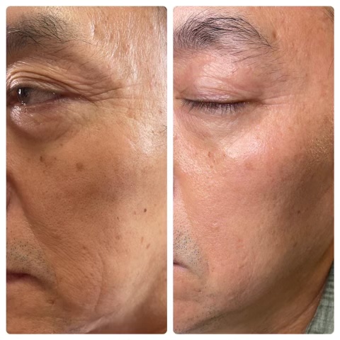 ProCell Microchanneling Treatment Before and After Pictures in Oklahoma City, OKC