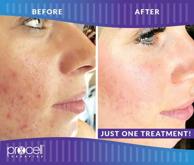 Acne Scars Before and After Photos at Petra’s Massage Therapy & Weight Loss Clinic in Oklahoma City